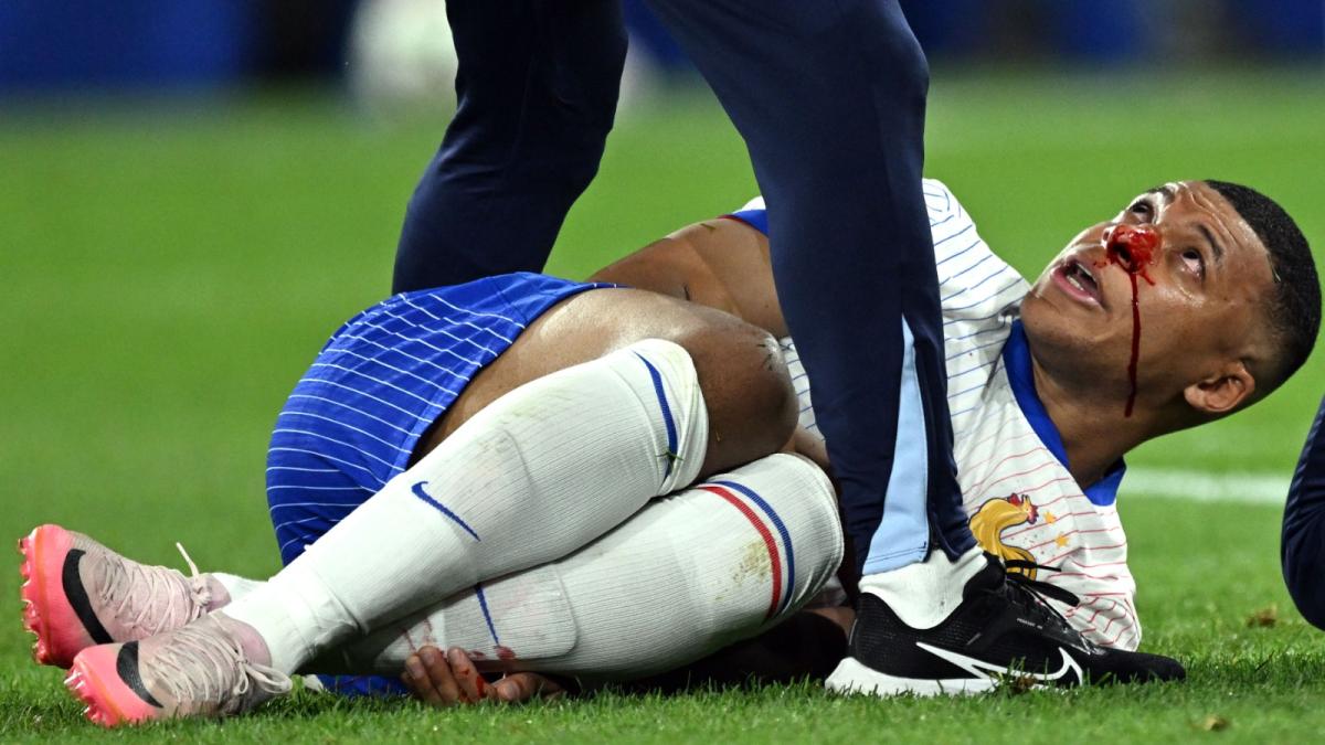 Kylian Mbappè lascia il campo sanguinante: naso rotto per il campione del Real Madrid, ecco le sue condizioni